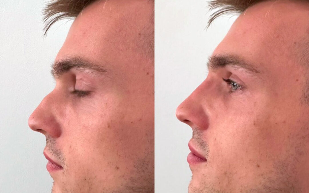 Rhinoplastie par chirurgie