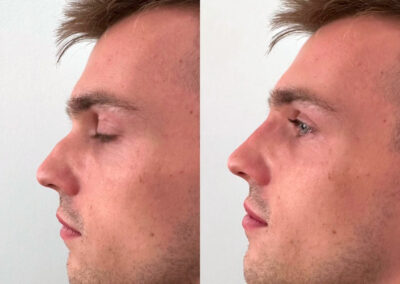 Rhinoplastie par chirurgie