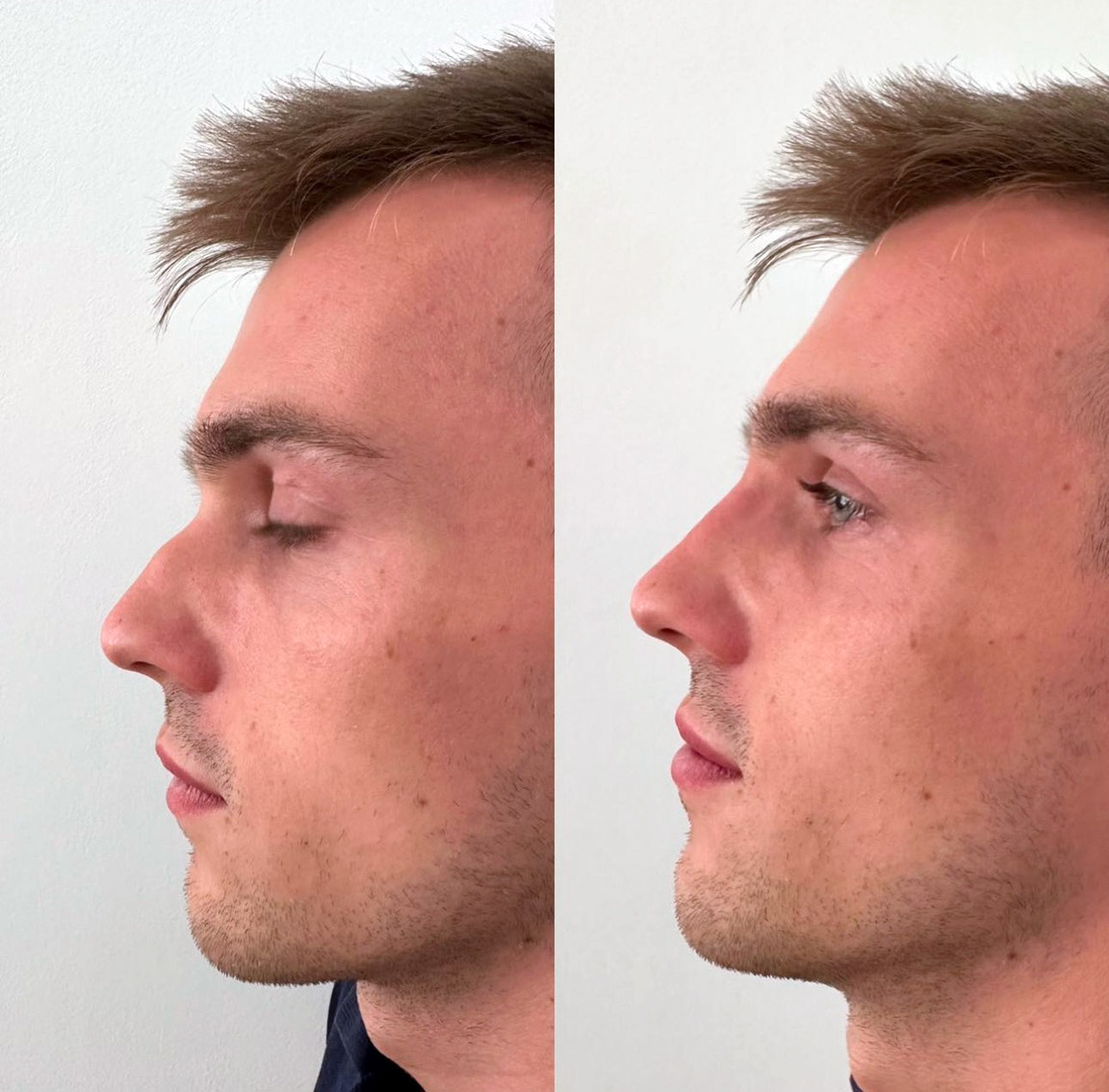 rhinoplastie-2 Rhinoplastie