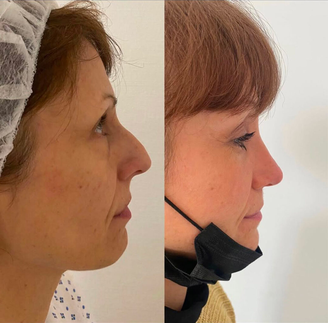 Rhinoplastie