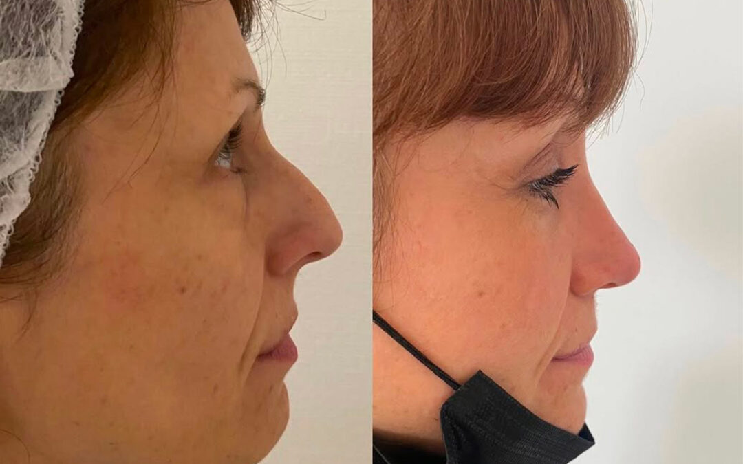 Rhinoplastie par chirurgie