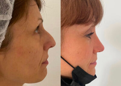 Rhinoplastie par chirurgie