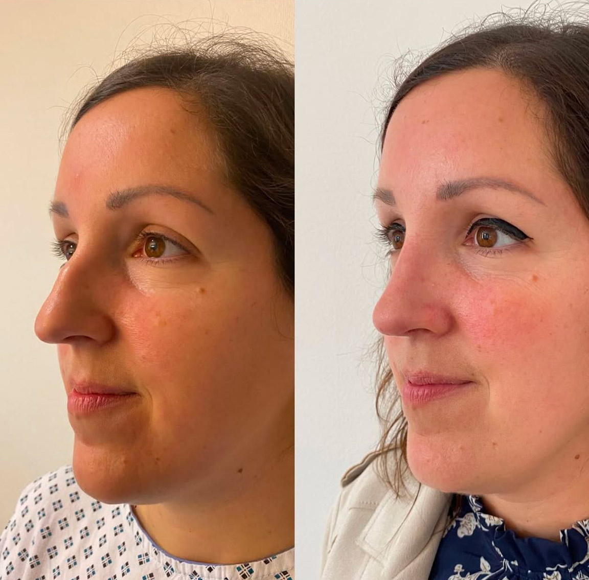 rhinoplastie-4 Rhinoplastie