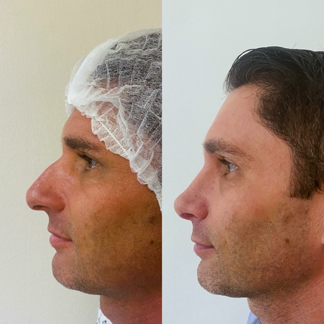 Rhinoplastie