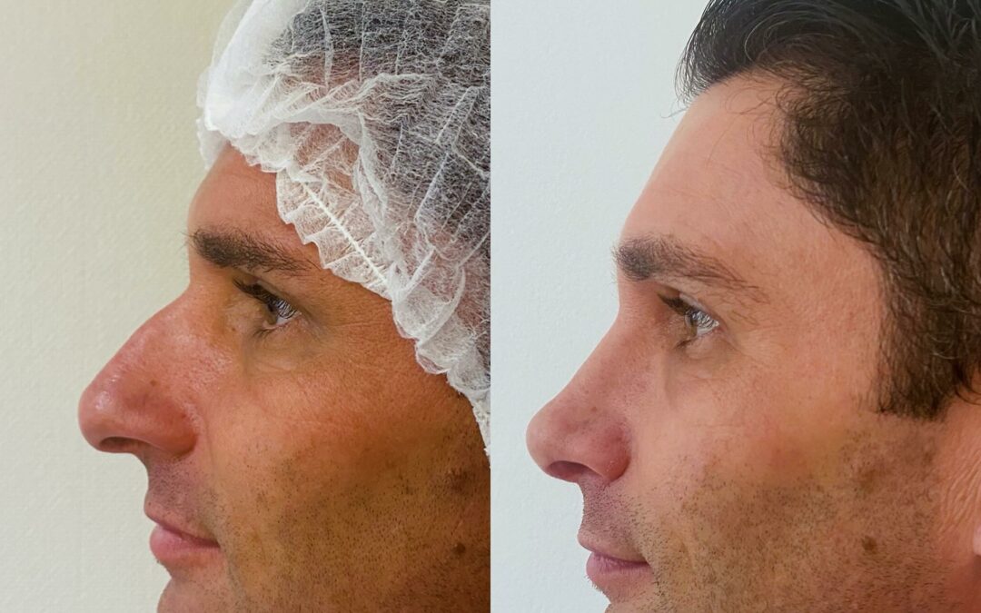 Rhinoplastie par chirurgie