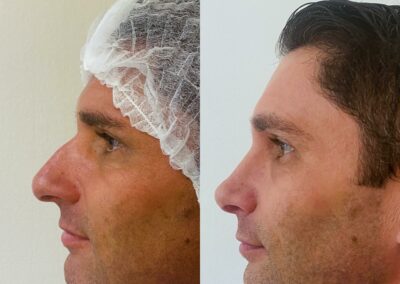 Rhinoplastie par chirurgie