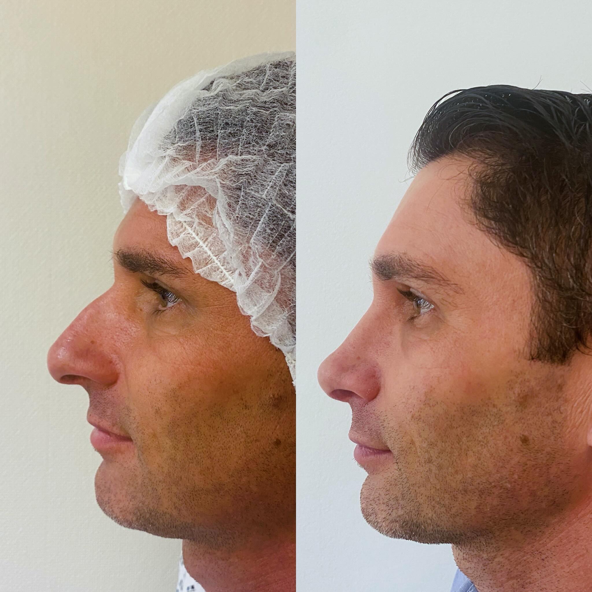 rhinoplastie-nez-intro Rhinoplastie