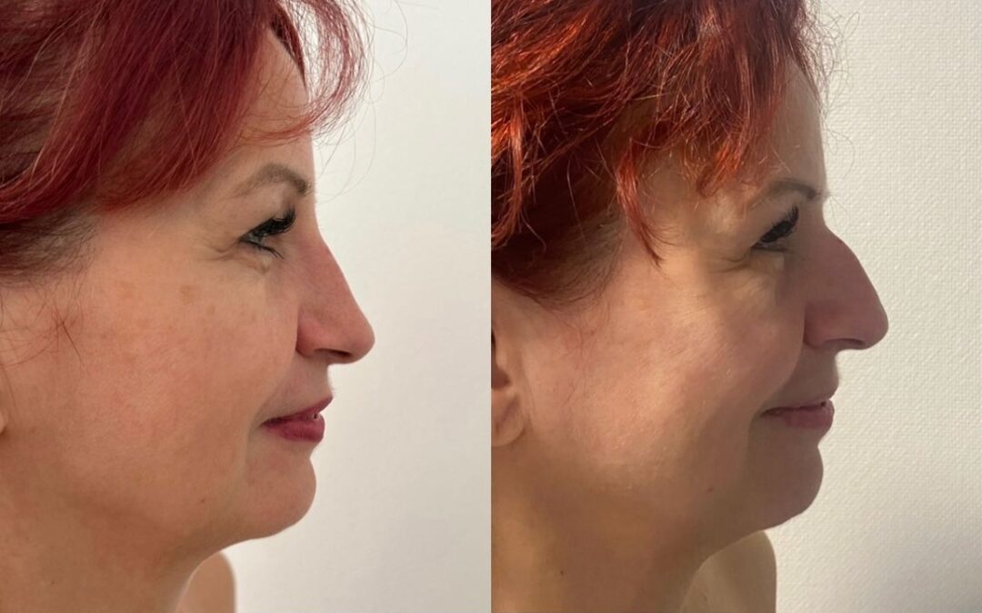 Rhinoplastie par chirurgie