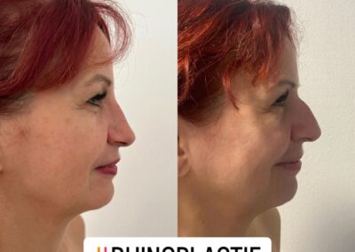 Rhinoplastie par chirurgie