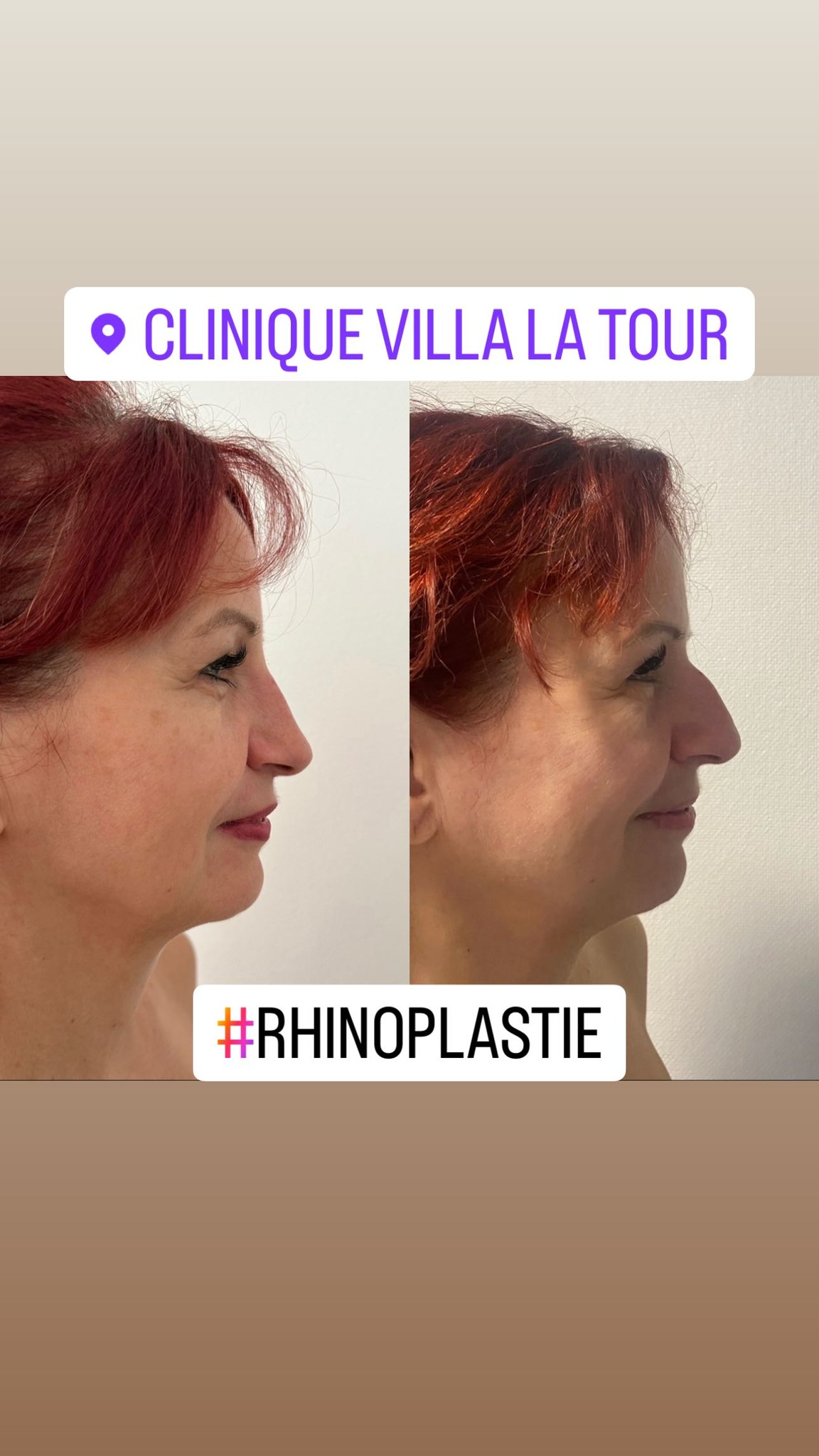 Rhinoplastie, Dr Letertre