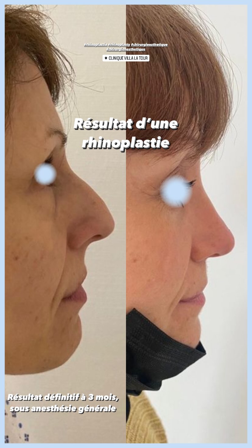 Rhinoplastie, dr Letertre