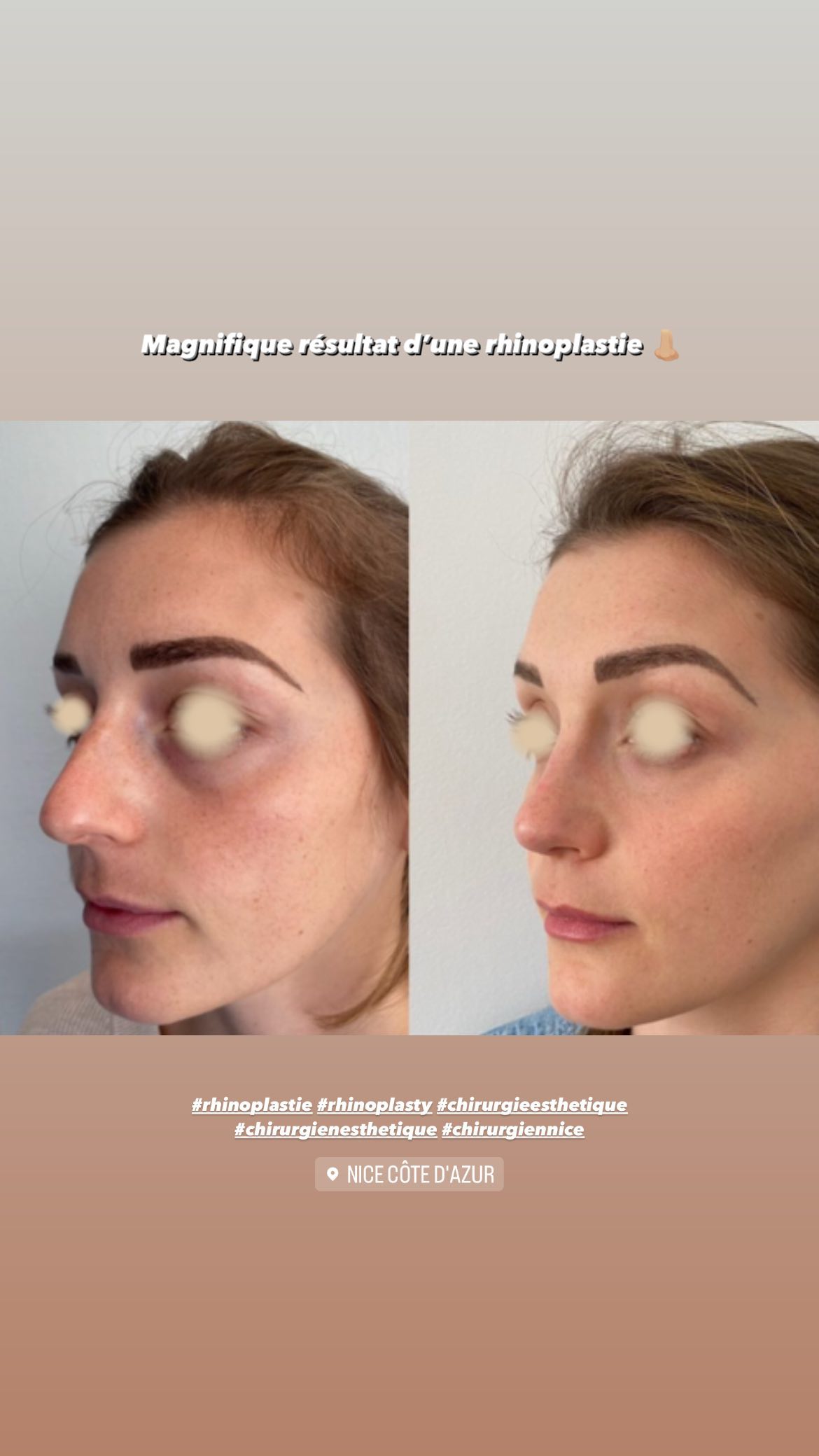 Rhinoplastie