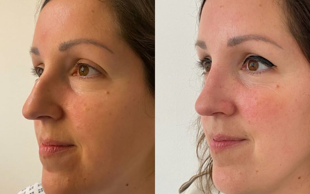 Rhinoplastie par chirurgie