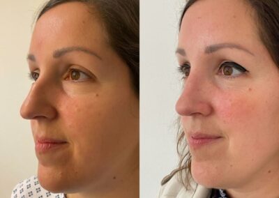 Rhinoplastie par chirurgie