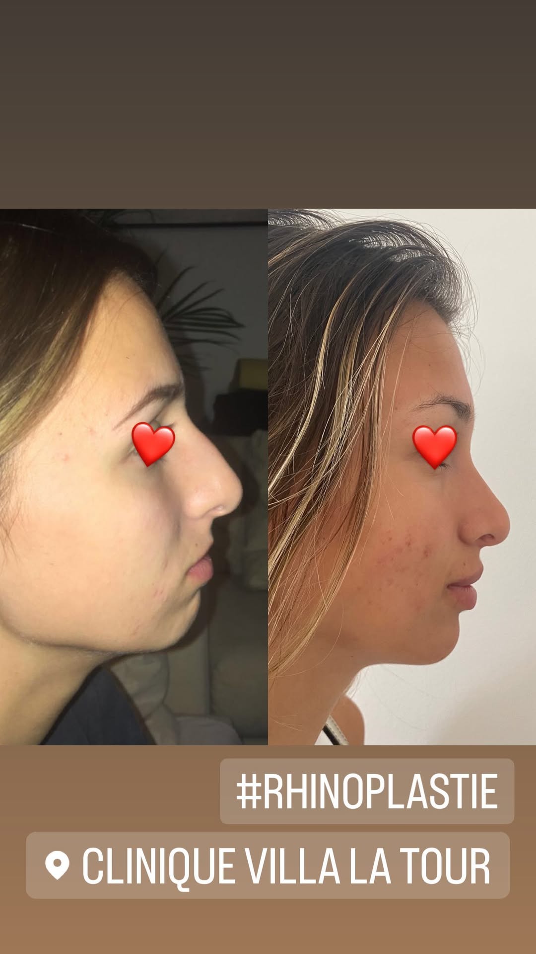 rhinoplastie5