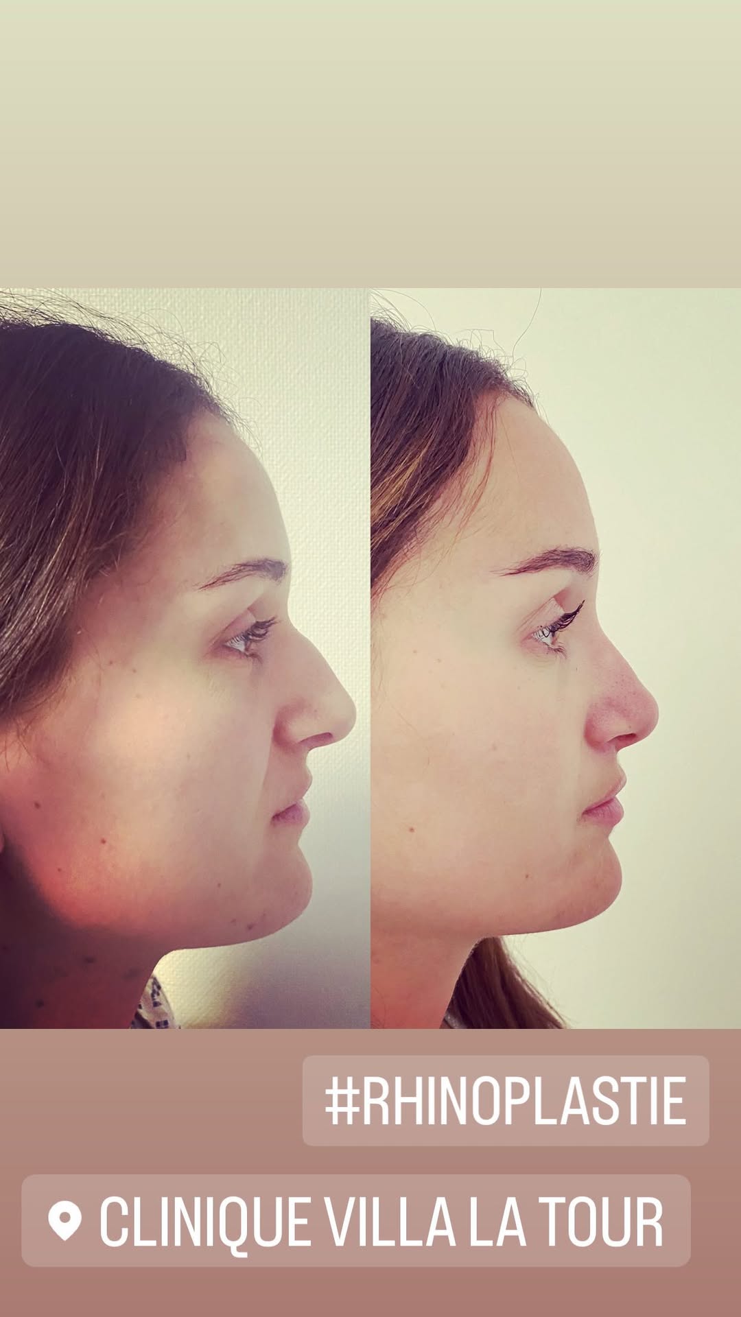 Rhinoplastie, Dr Letertre