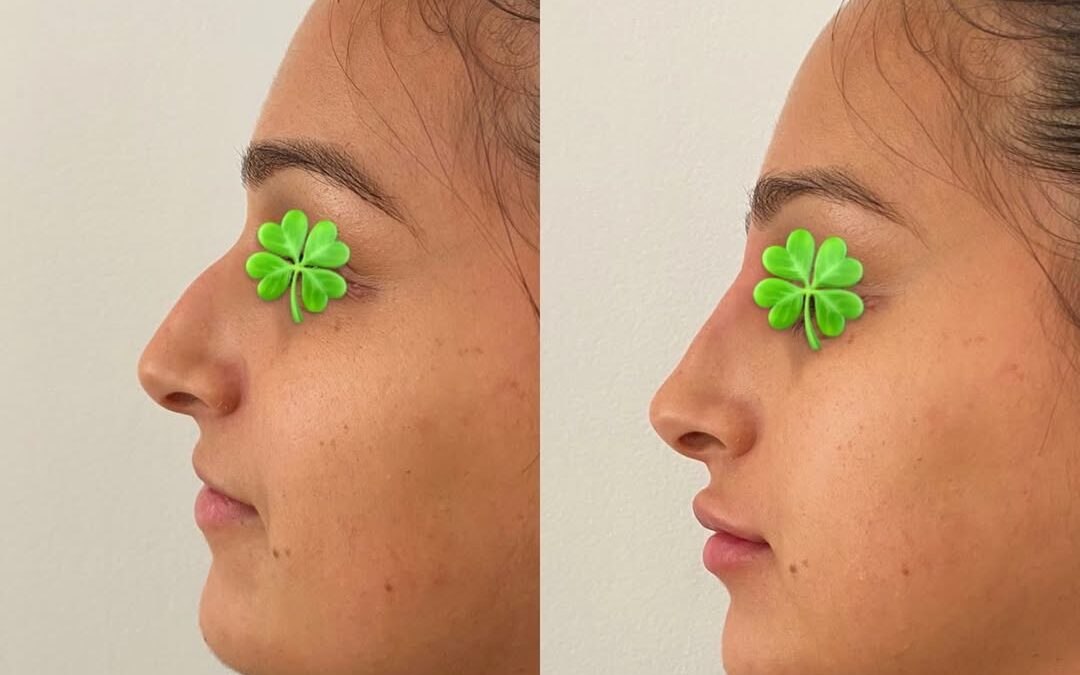 Rhinoplastie avec acide hyaluronique