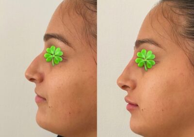 Rhinoplastie avec acide hyaluronique