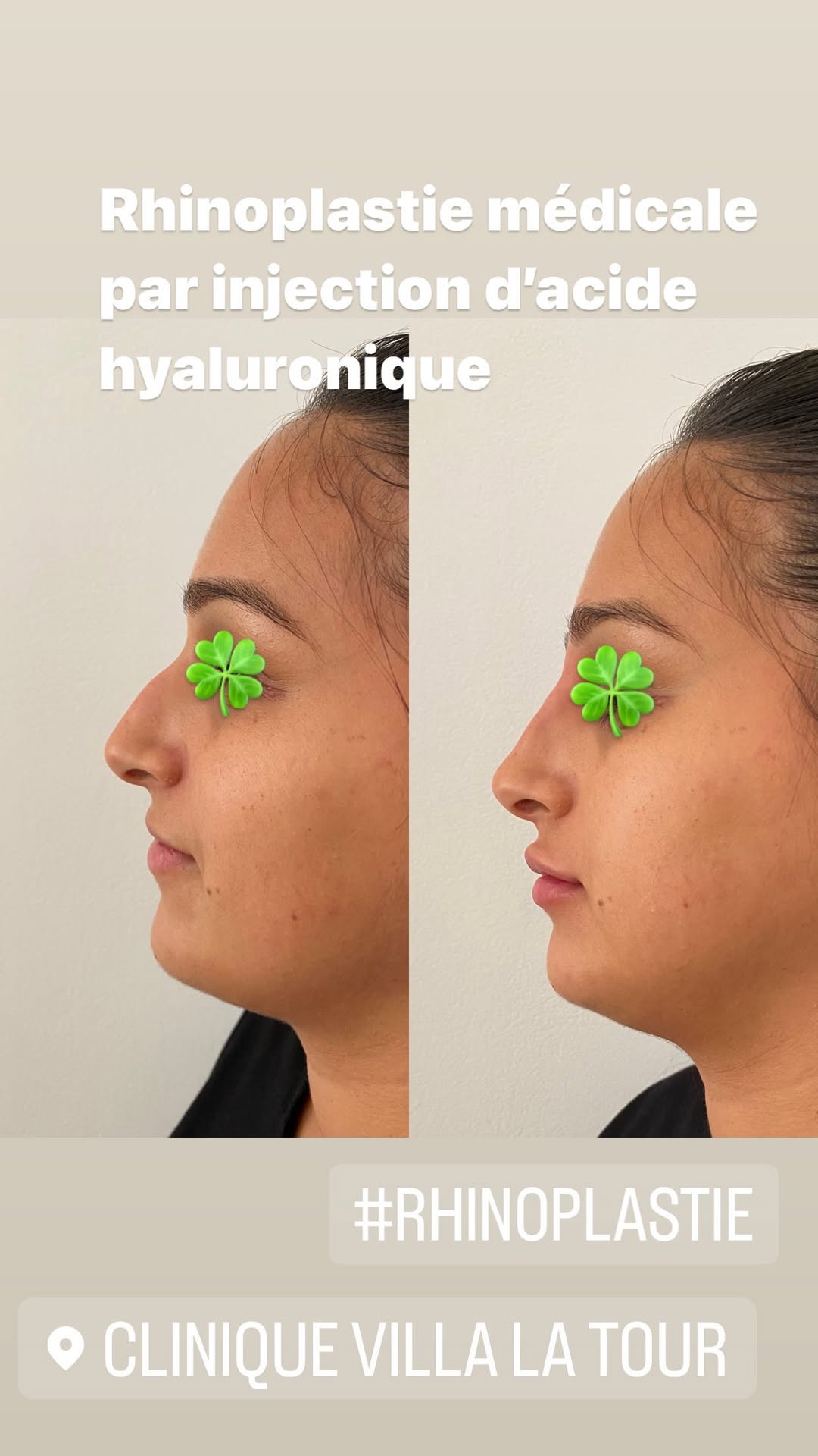 Rhinoplastie, Dr Letertre
