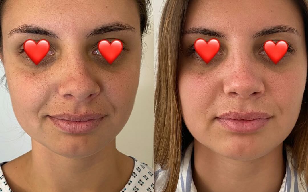 Rhinoplastie par chirurgie