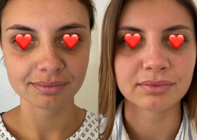 Rhinoplastie par chirurgie