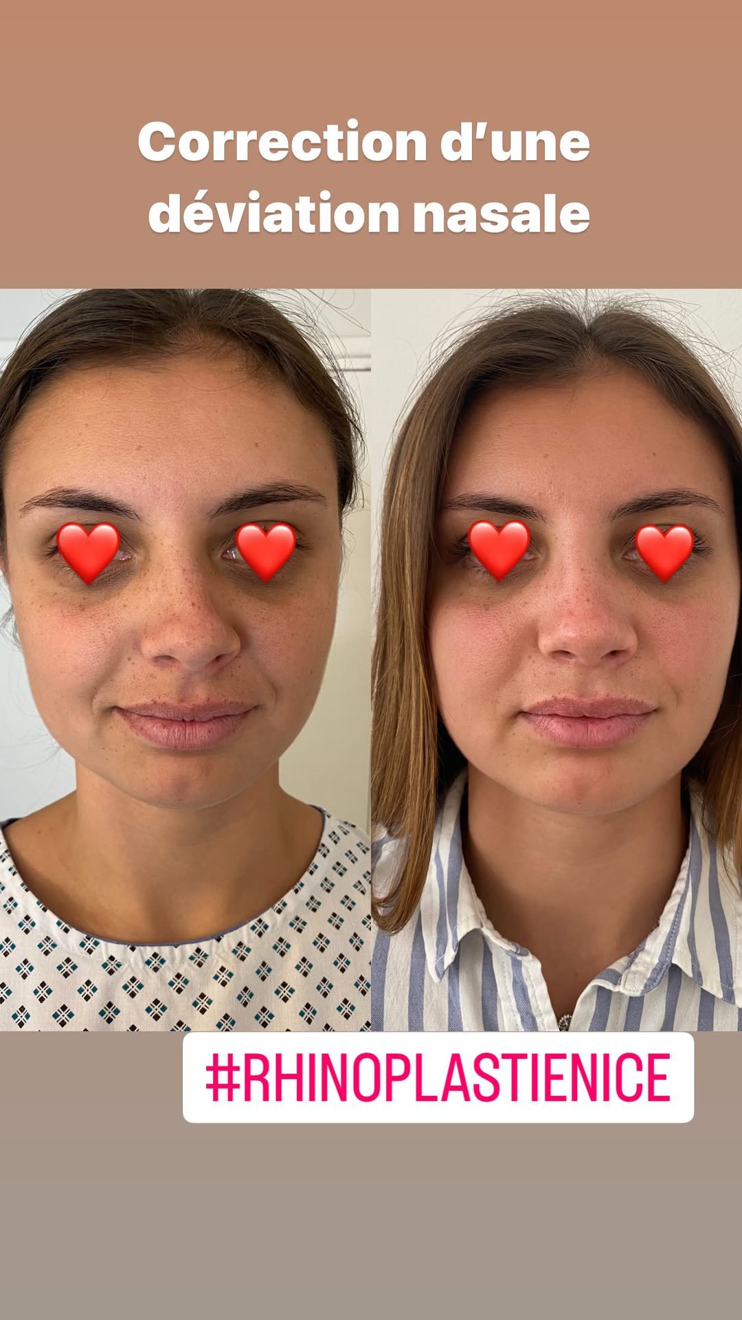 Rhinoplastie, Dr Letertre