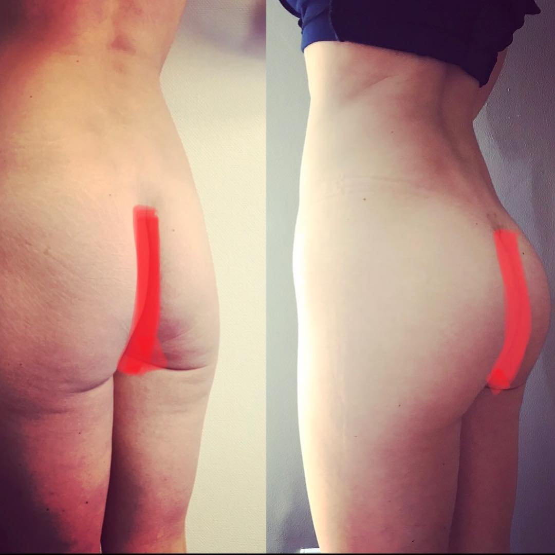 Fesses-prothèses Lipofilling-fesses