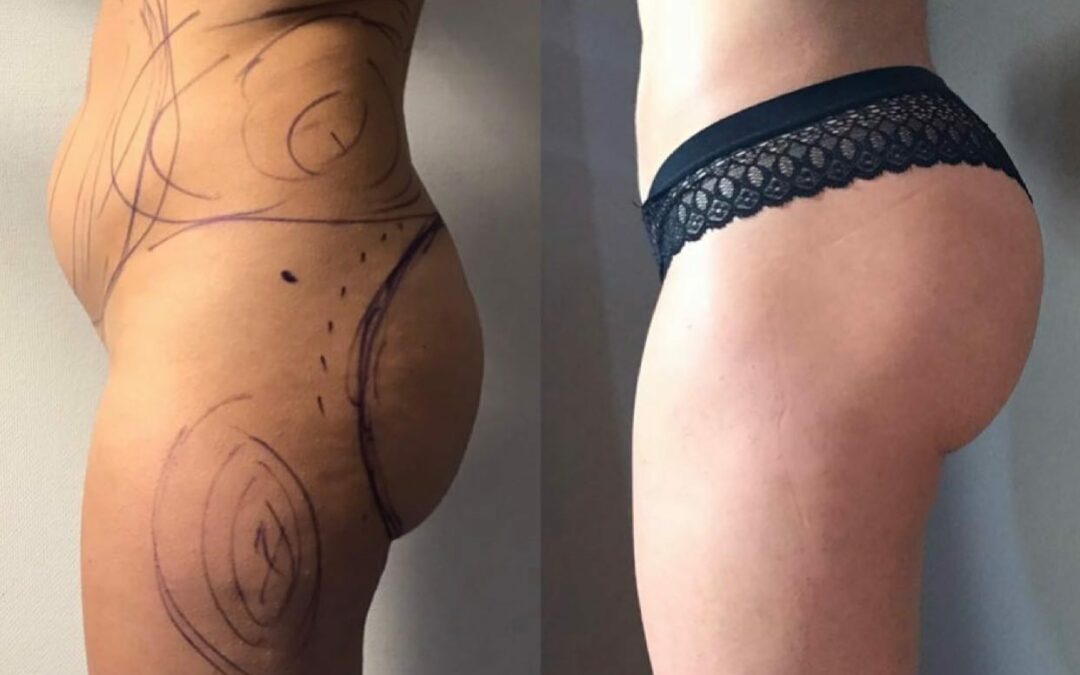 Lipofilling des fesses