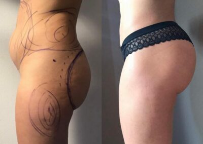 Lipofilling des fesses