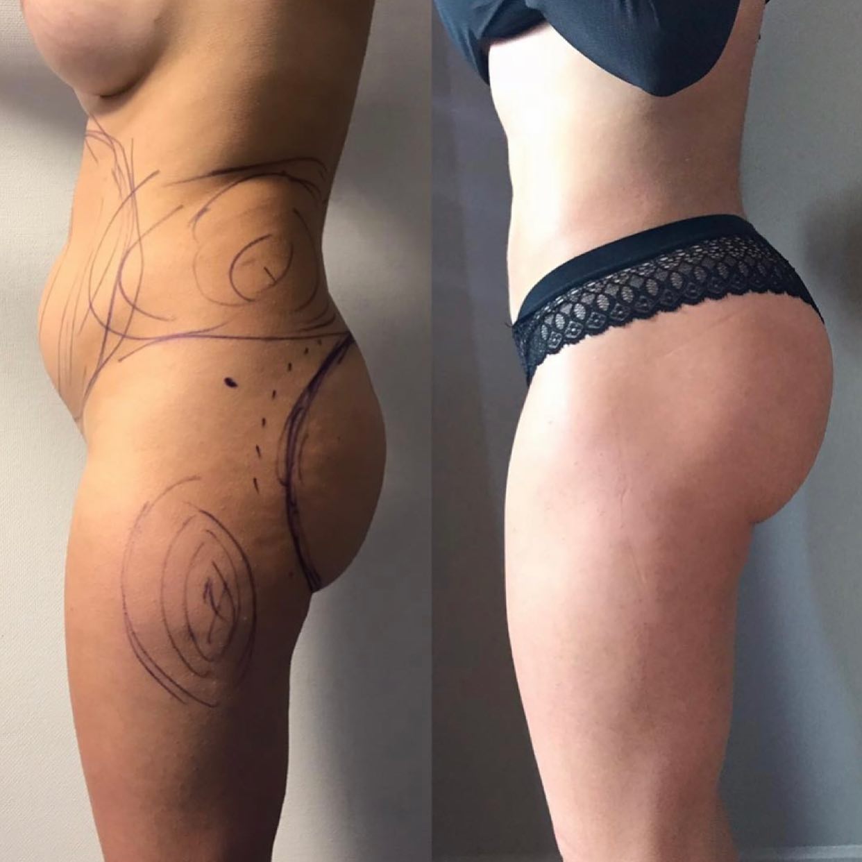 Lipofilling des fesses