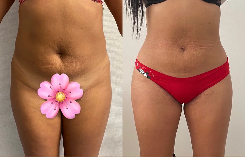 Liposuccion-1 Liposuccion ventre, dos et lipofilling de fesses