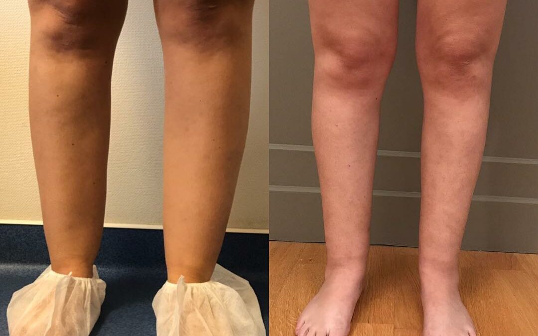 Liposuccion des mollets