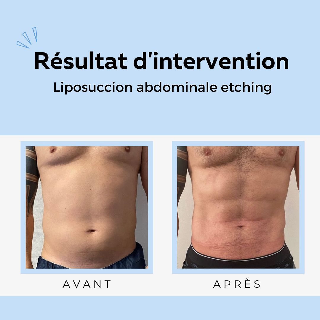 Liposuccion-9 Liposuccion abdominale etching