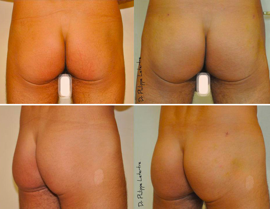 fesses-macrolane Lipofilling-fesses