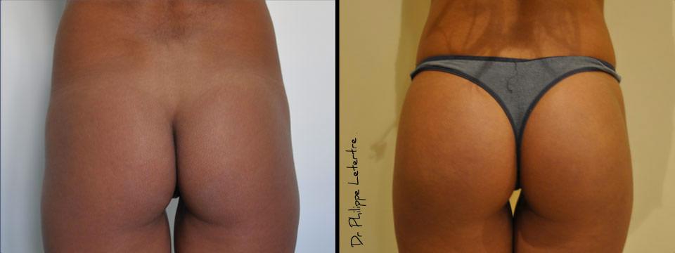 fesses-protheses-1 Lipofilling-fesses