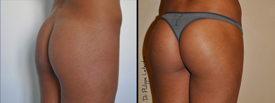 fesses-protheses-2 Lipofilling-fesses