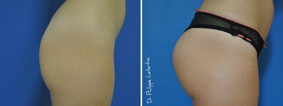 fesses-protheses-3 Lipofilling-fesses