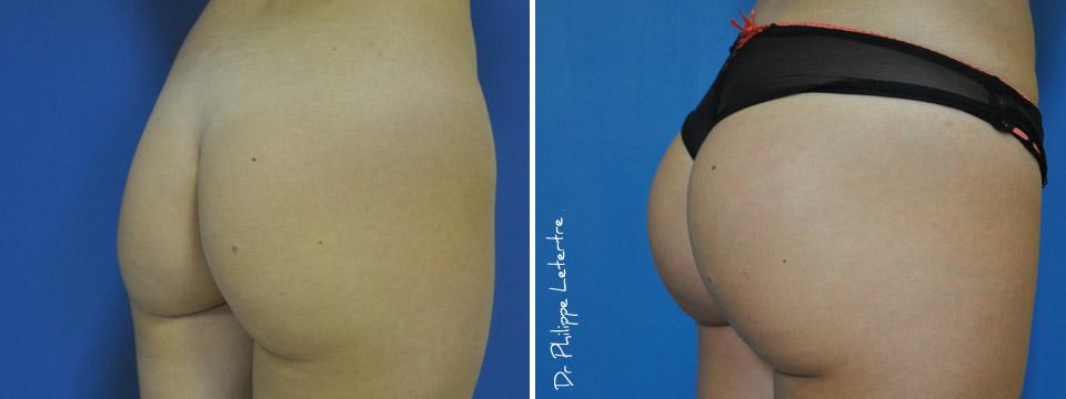 fesses-protheses-4 Lipofilling-fesses