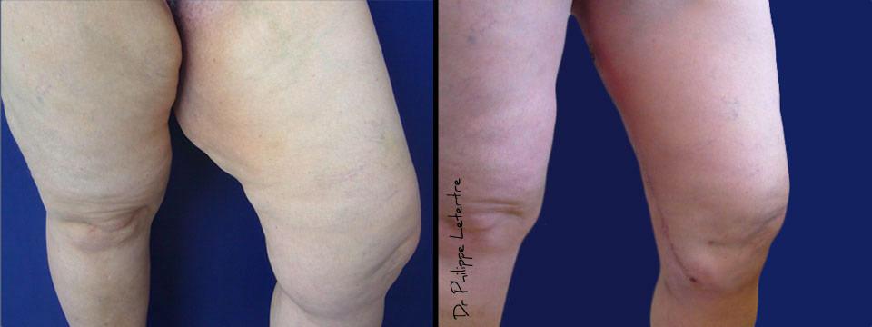 lifting-cuisse-1 Lifting cuisses