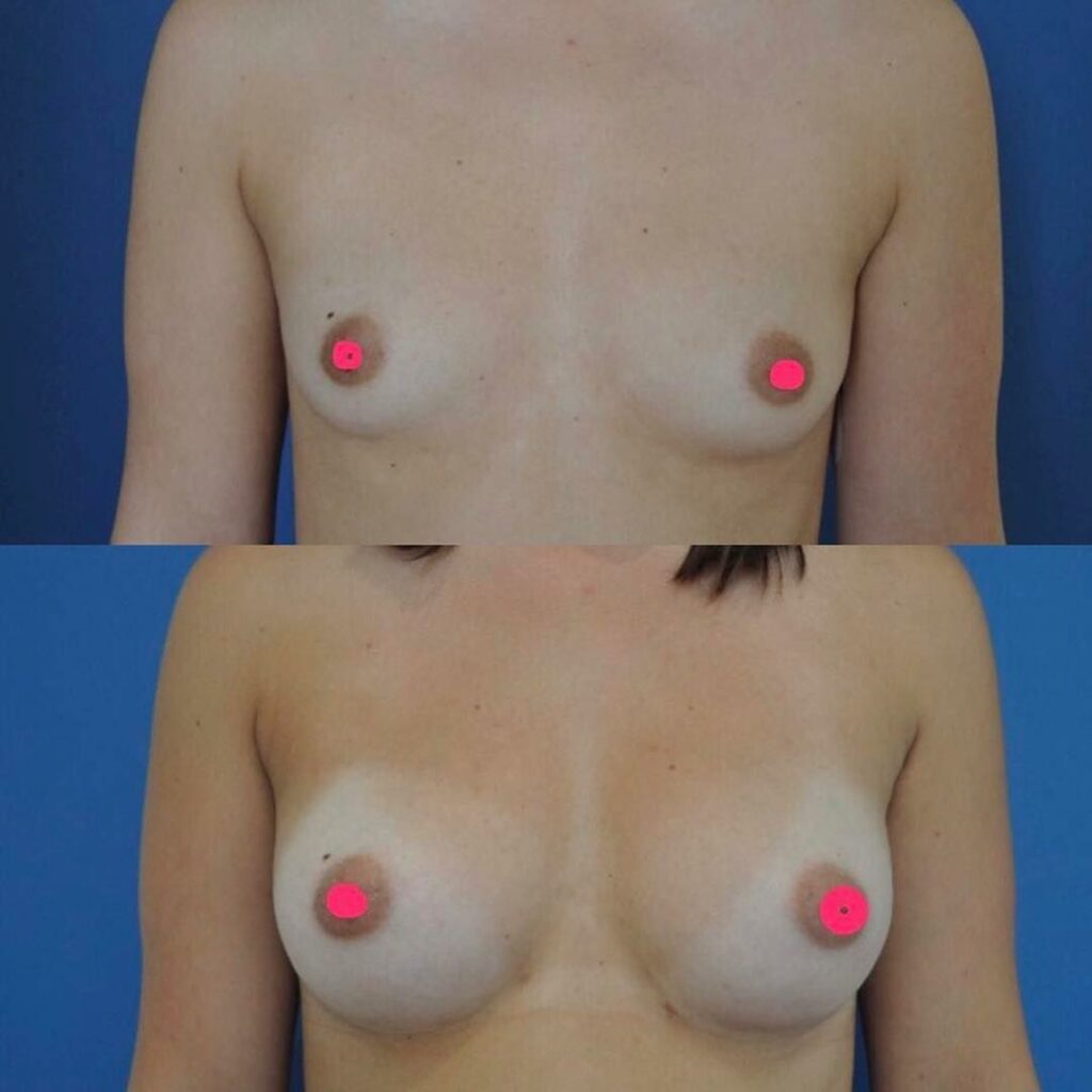 Lipofilling des seins