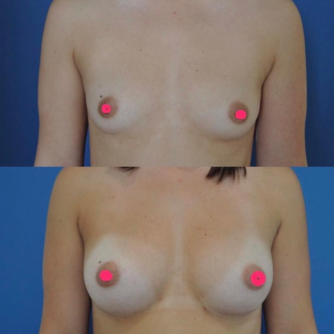 lipofilling-seins-1 Lipofilling des seins