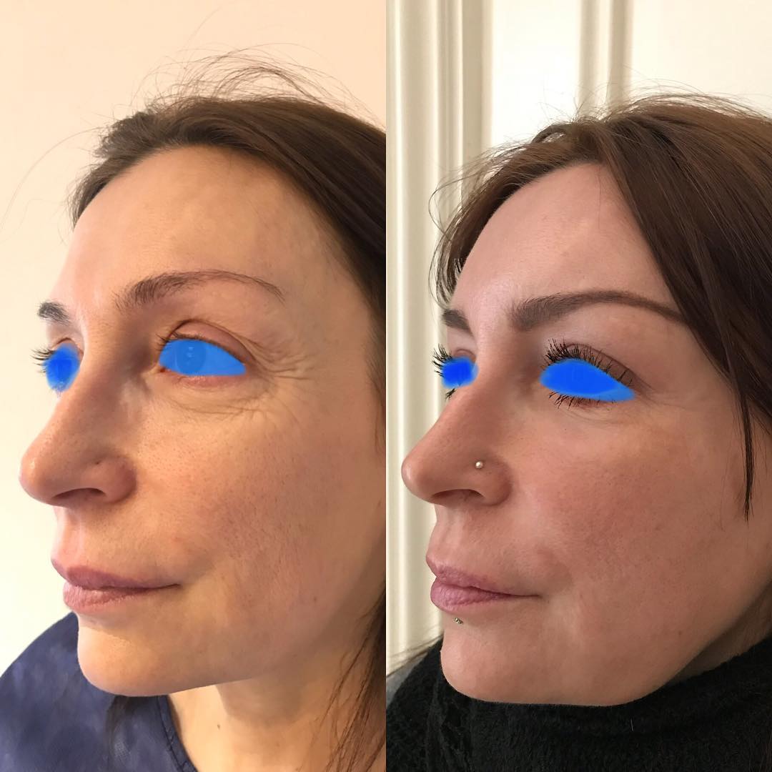 lipofilling-visage-2 Lipofilling ou lipostructure de Coleman