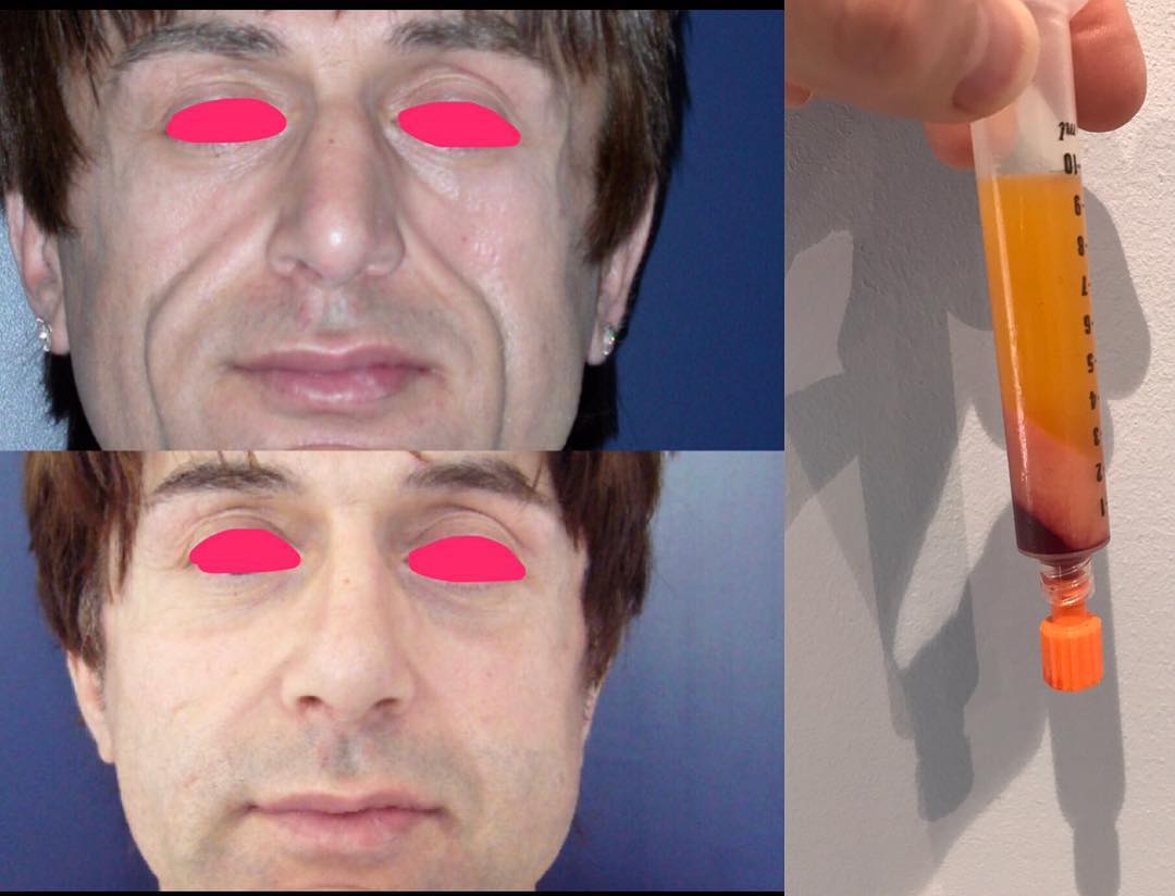 lipofilling-visage Lipofilling ou lipostructure de Coleman