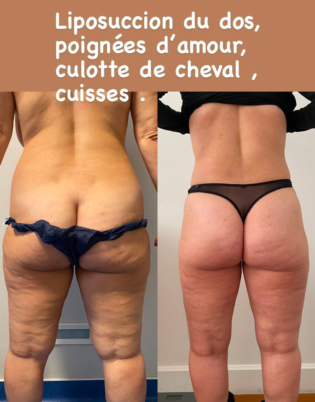 liposuccion-dos-culotte-de-cheval-fesses-cuisses Liposuccion des fesses