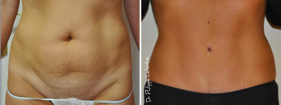 plastie-abdominale-3 Plastie-abdominale
