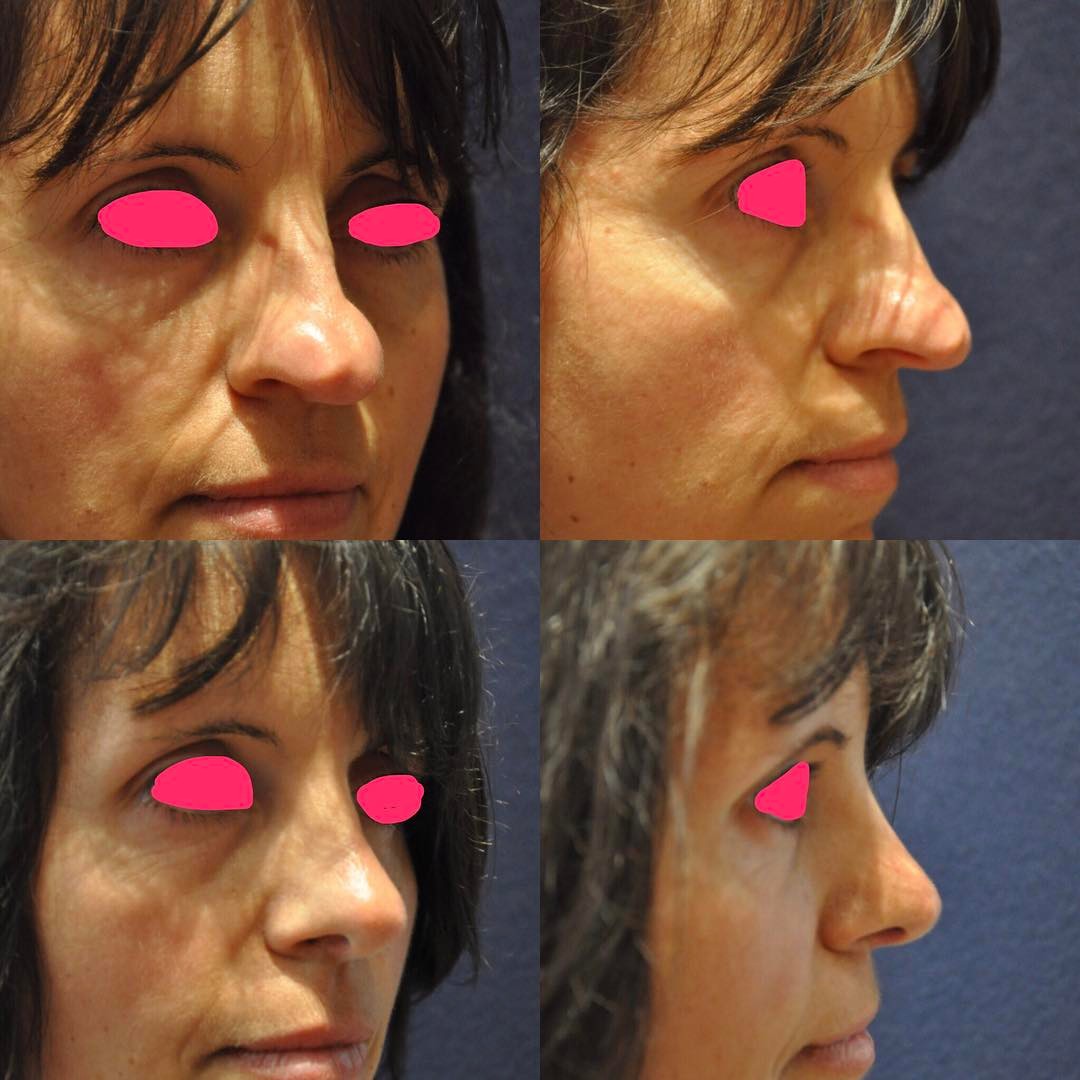 rhinoplastie-11 Rhinoplastie