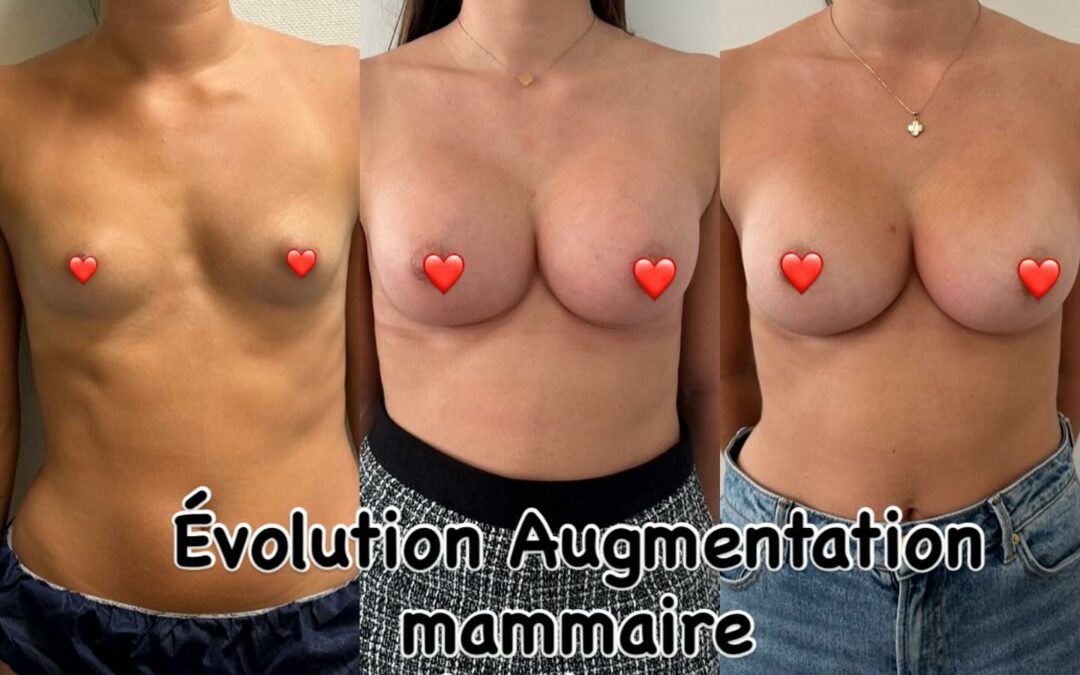 Augmentation des seins par protheses