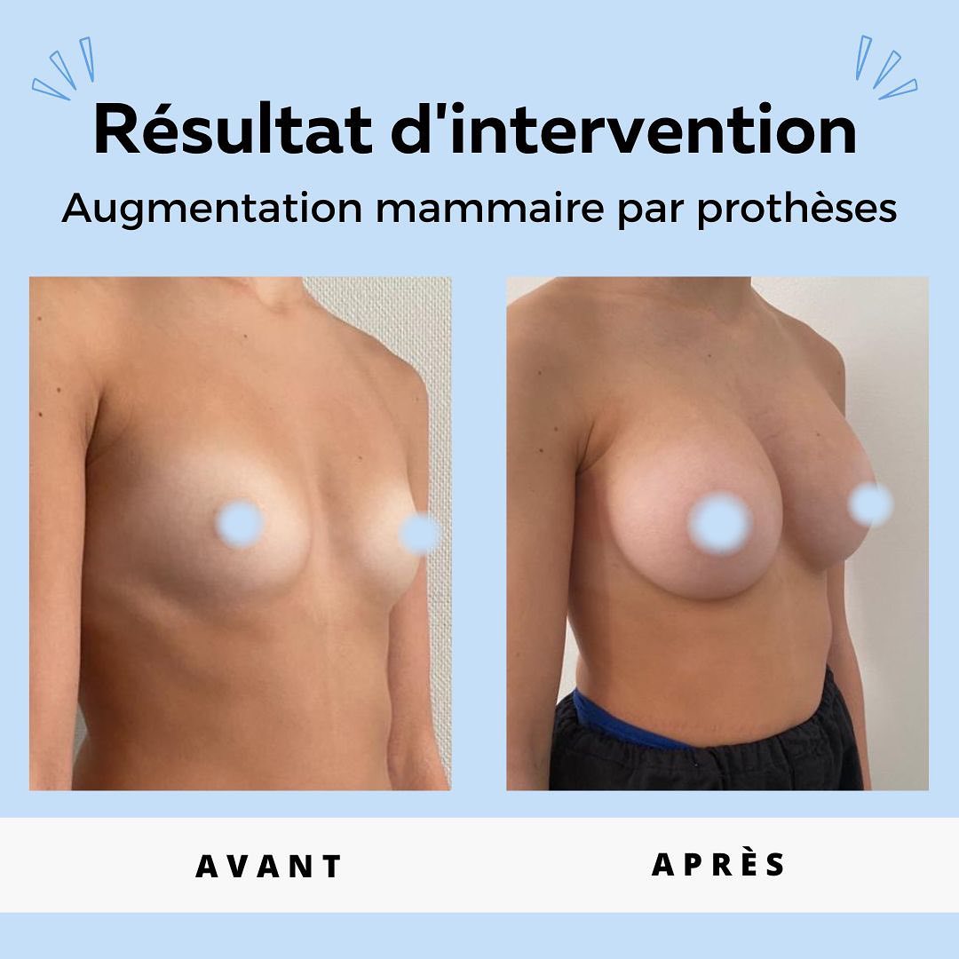 Augmentation-mammaire- protheses-1 Augmentation mammaire par prothèses
