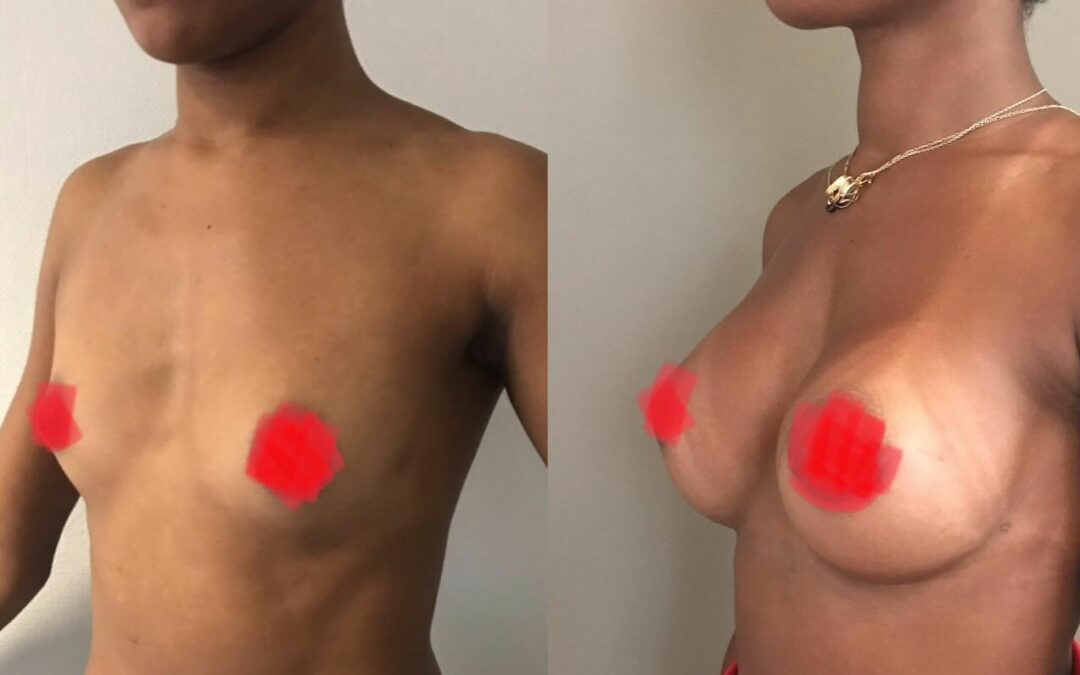 Augmentation mammaire par prothèses