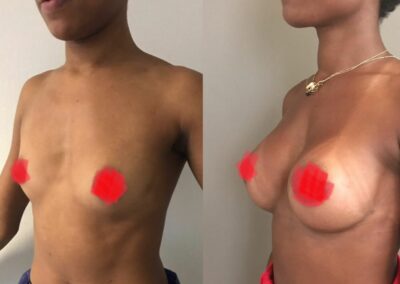 Augmentation mammaire par prothèses